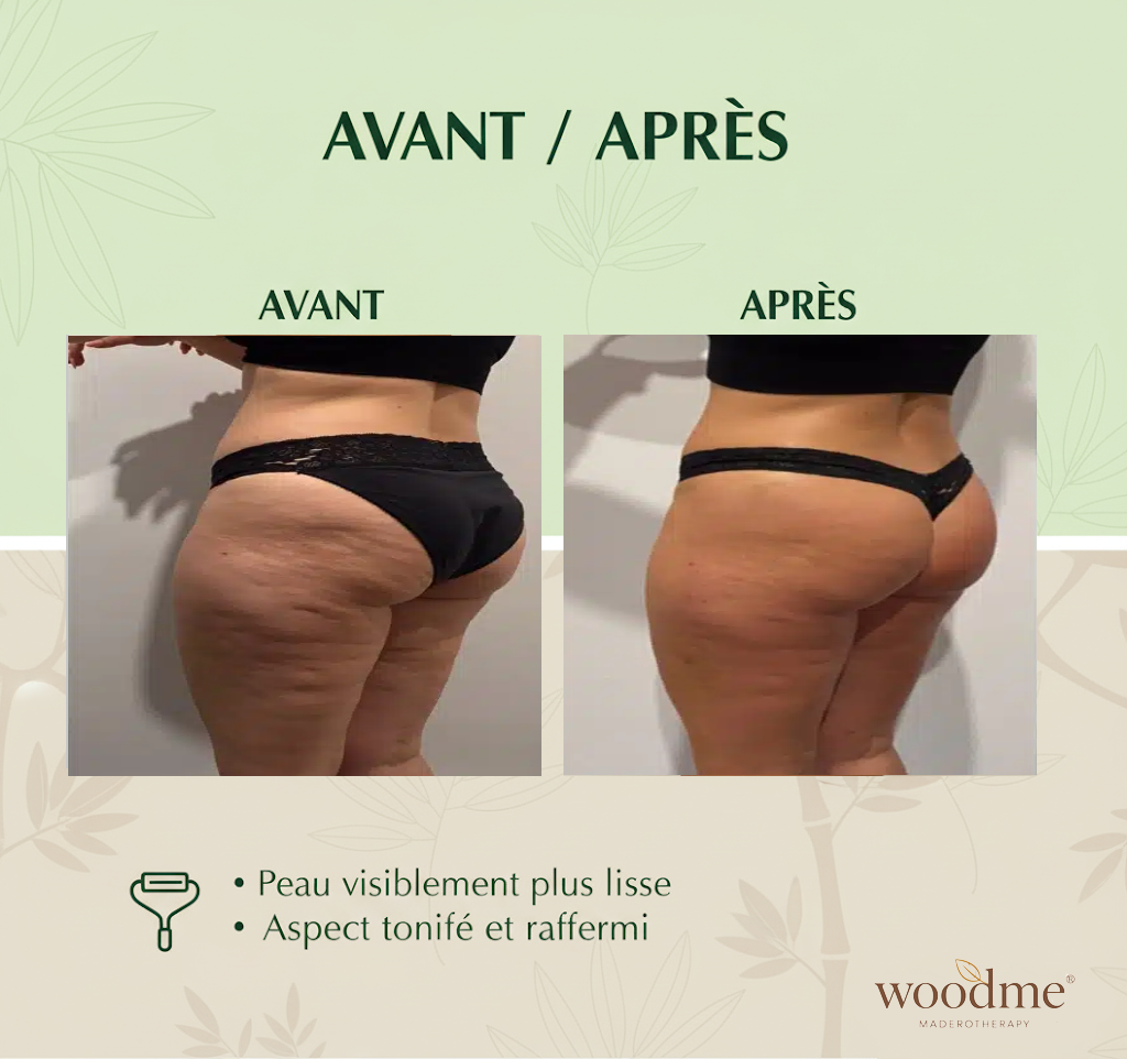 Woodme - Maderotherapy Kit